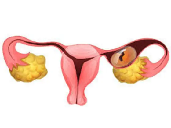 ectopic-pregnancy