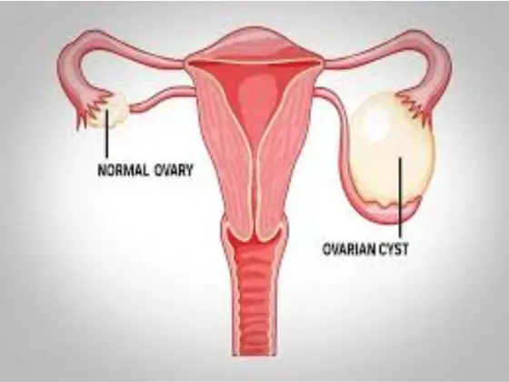 ovarian-cyst