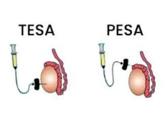tesa-pesa